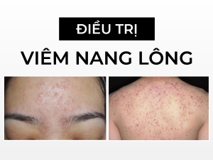 điều trị viêm nang lông