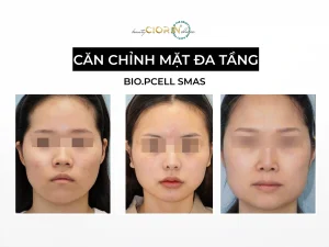căn chỉnh gương mặt đa tầng