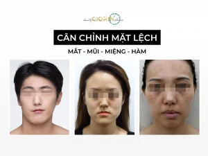 cân chỉnh mặt lệch tại CIORIN