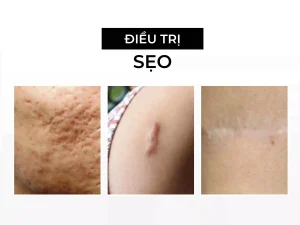 điều trị sẹo tại CIORIN