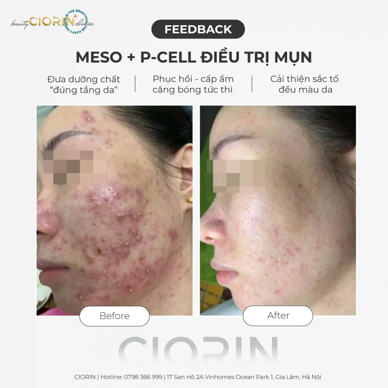 feedback trị mụn CIORIN