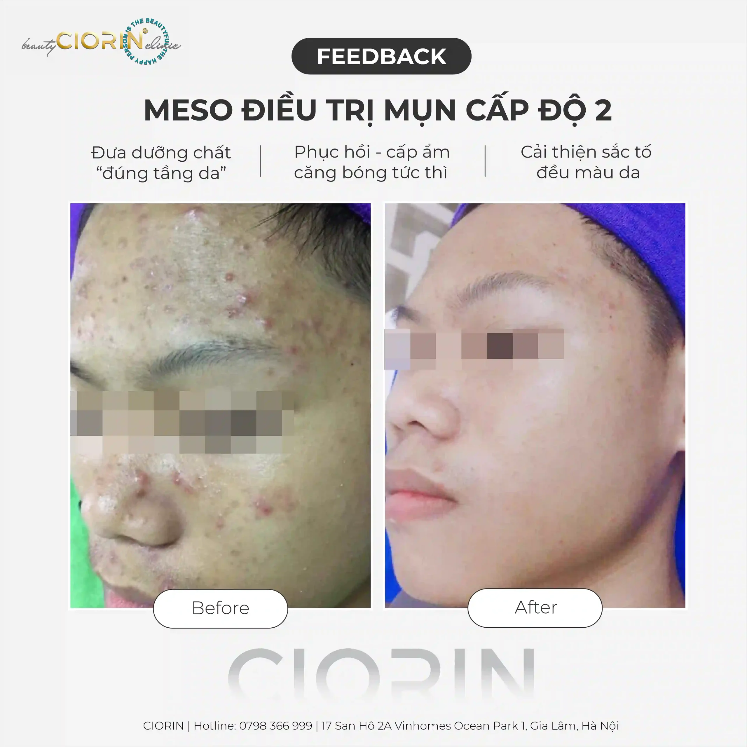 feedback trị mụn