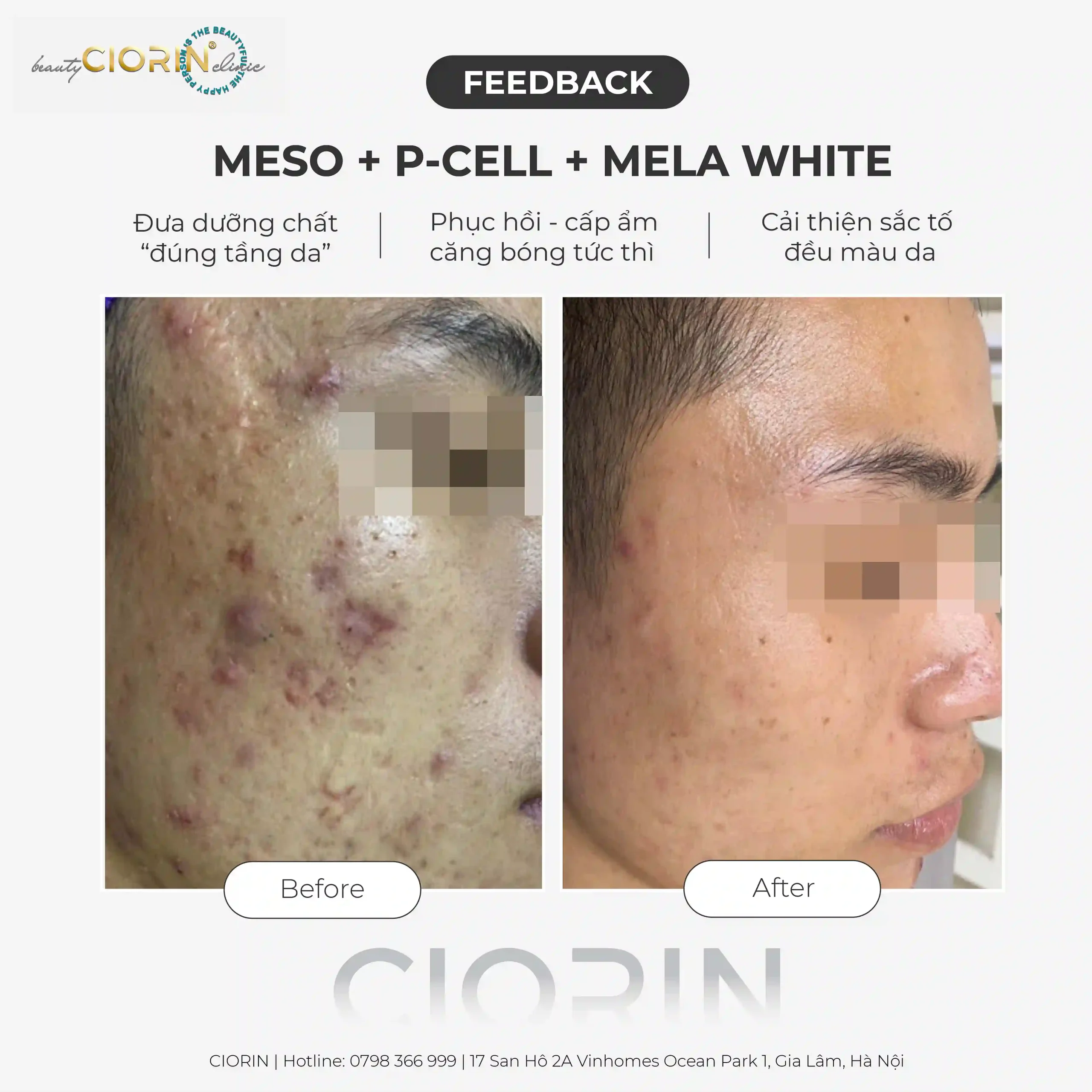feedback trị mụn ciorin