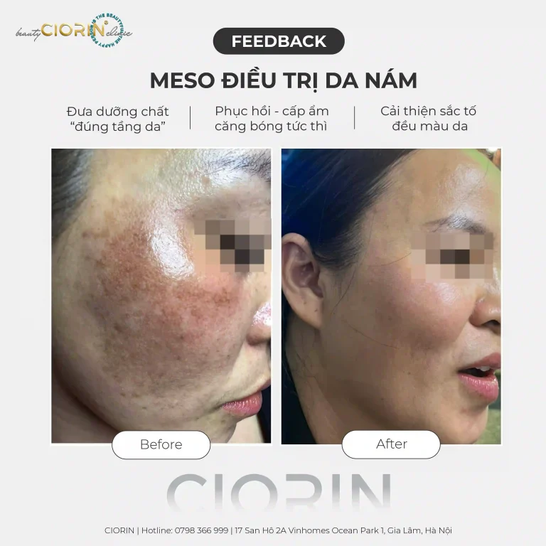 feedback trị nám CIORIN