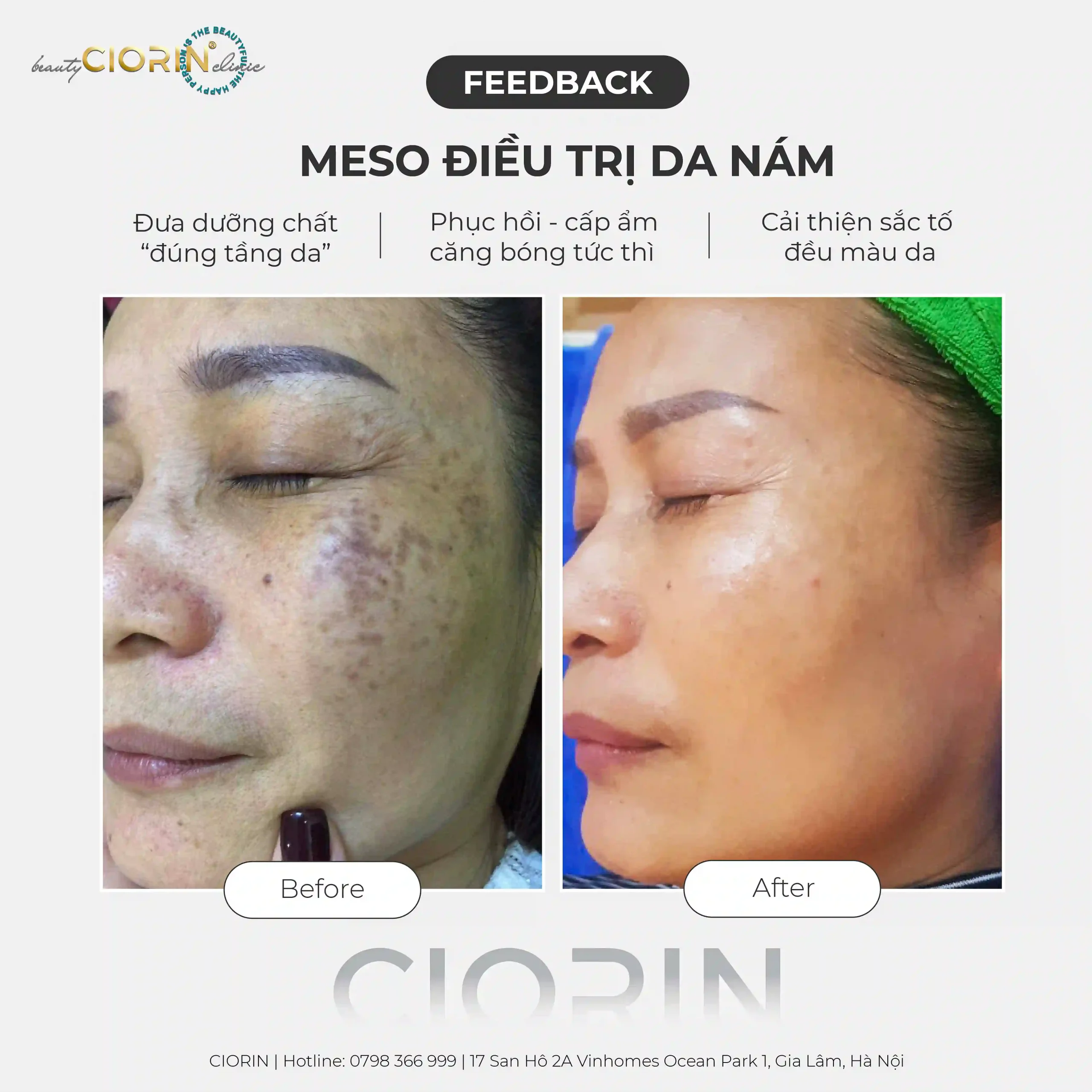 feedback trị nám CIORIN